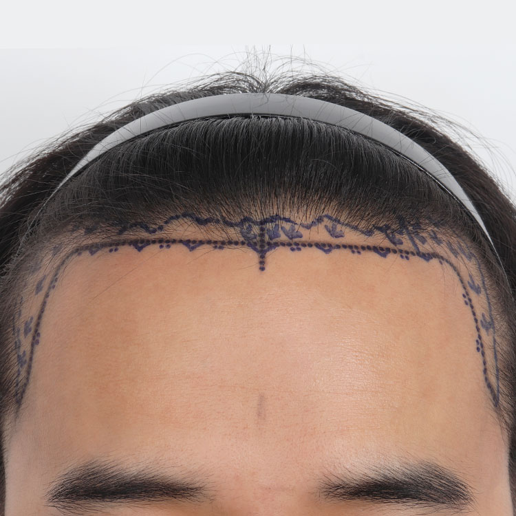 치료 전