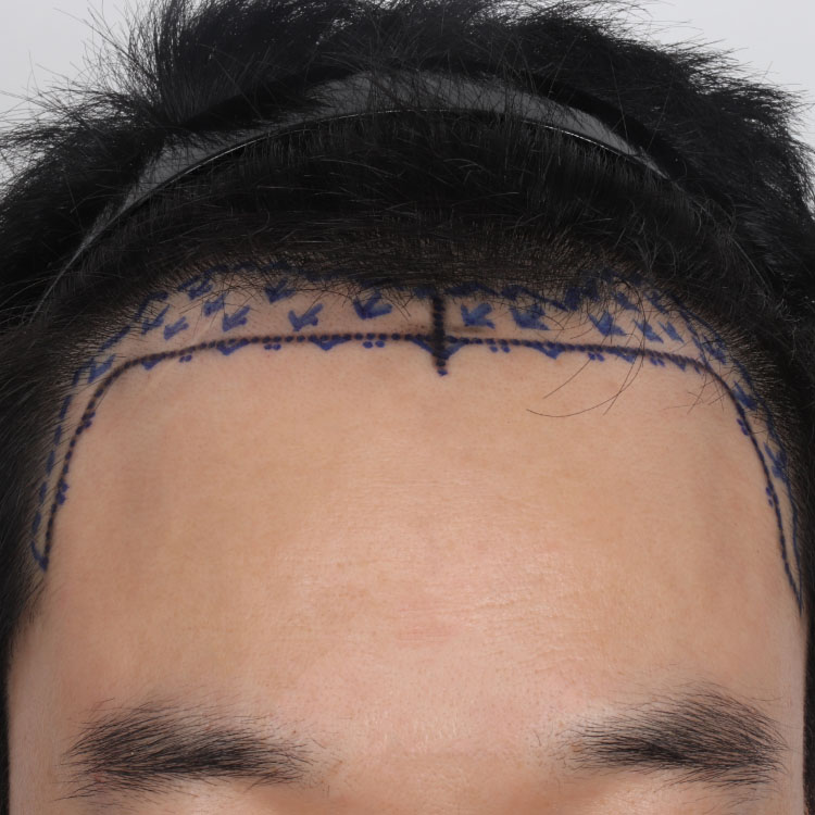 치료 전