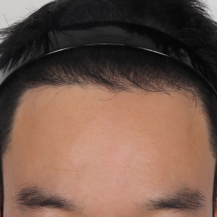 치료 후